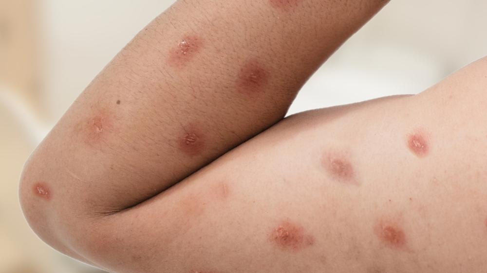 Ministério da Saúde confirma primeiro caso de Mpox no país