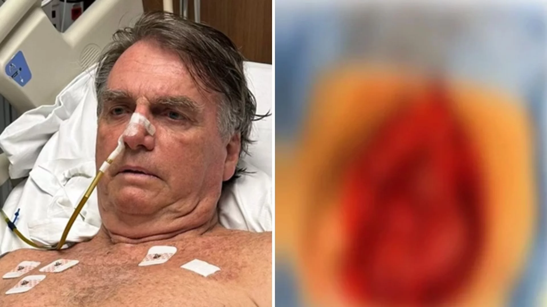 Bolsonaro choca e posta foto da barriga aberta, com intestino e vísceras expostos