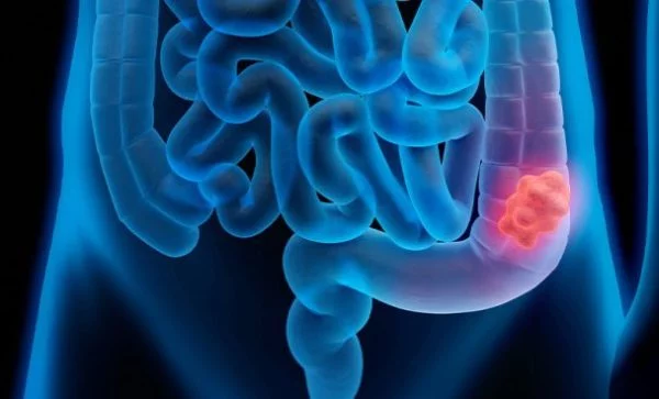 Diagnóstico tardio eleva mortes por câncer colorretal