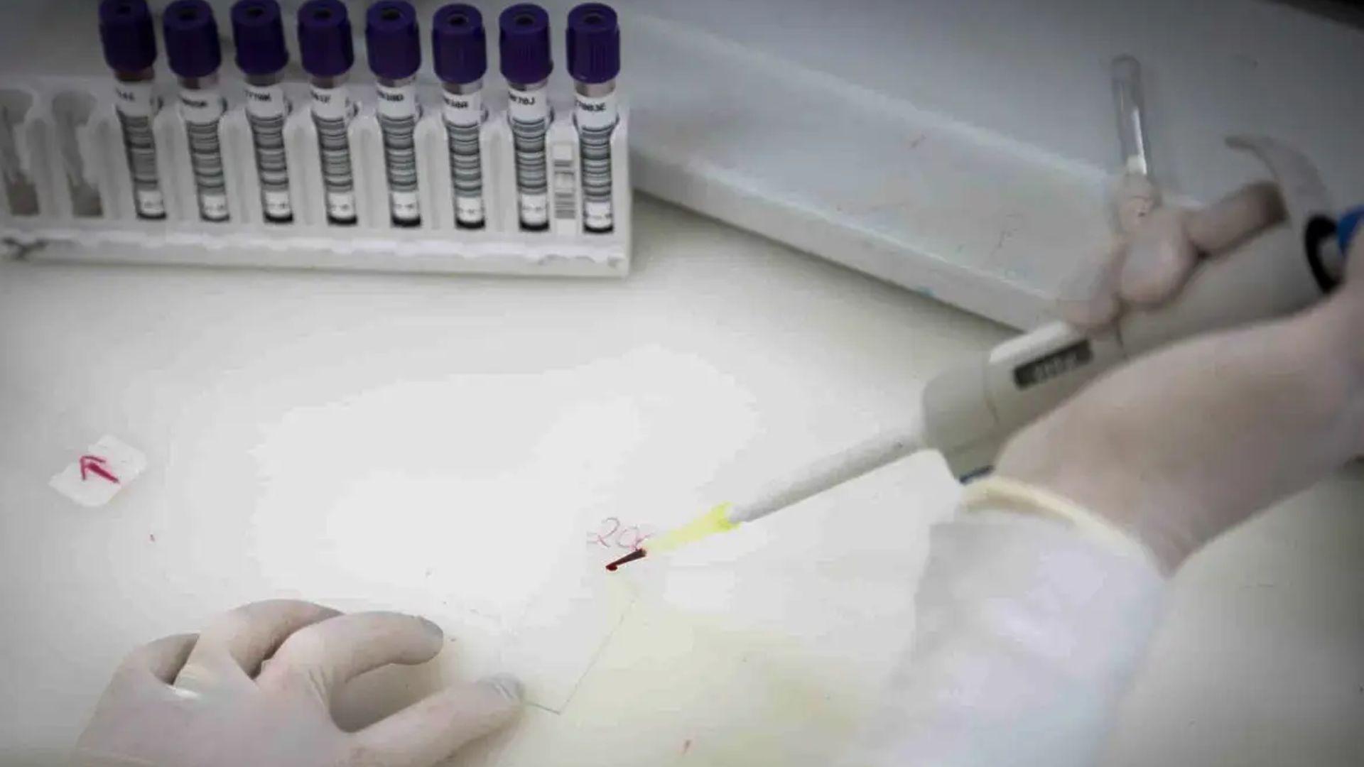 Paciente em SP com suspeita de ebola testa positivo para meningite