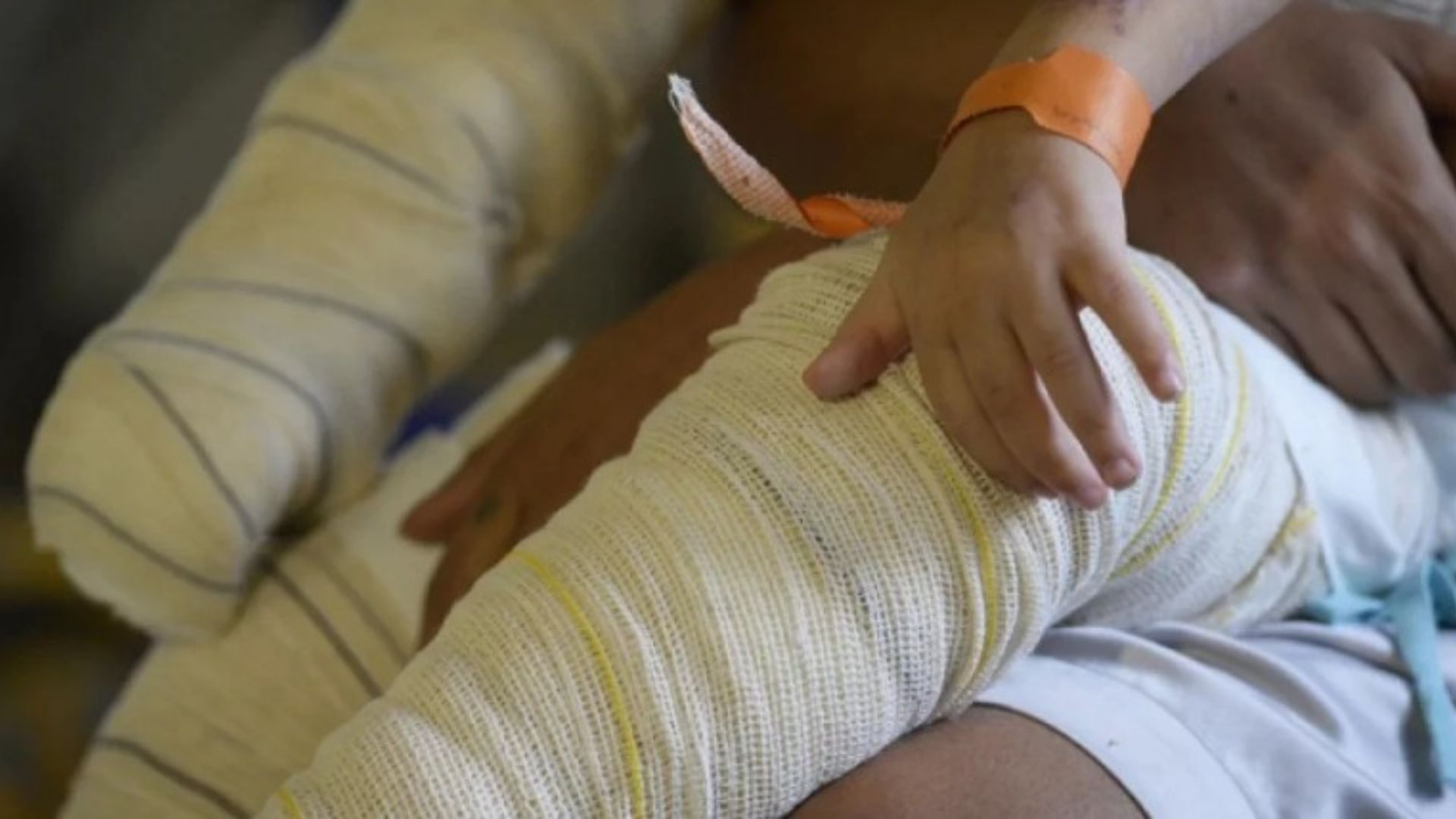 Maranhão tem o maior índice de hospitalização de crianças por queimadura